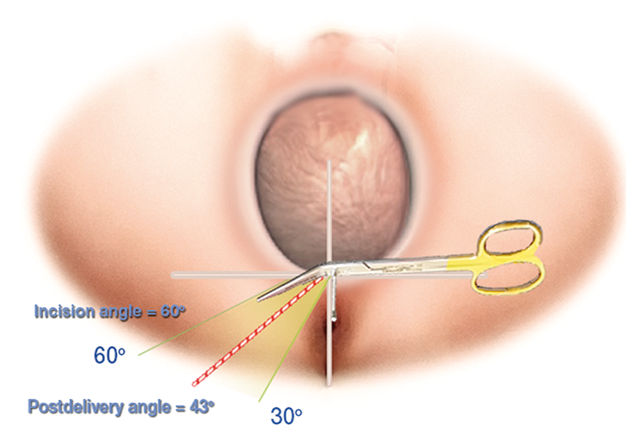 Episcissors the safe zone